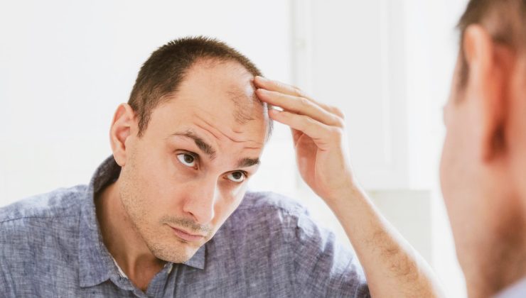 Erkeklerin en büyük kâbuslarından… Saç dökülmesinin 3 nedeni